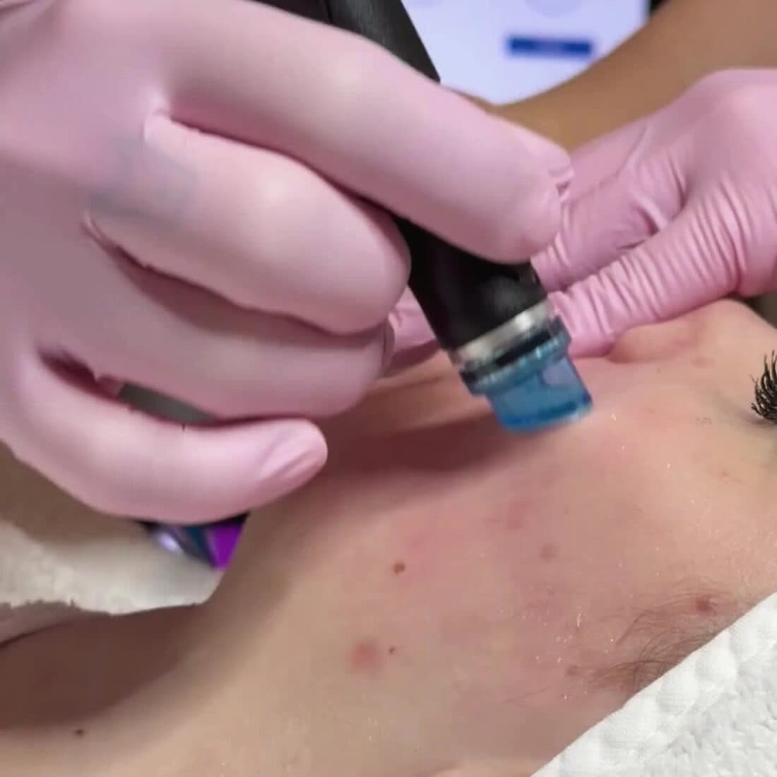 Behandelte Hand in Handschuhen arbeitet mit einem Gerät an einem Fußnagel